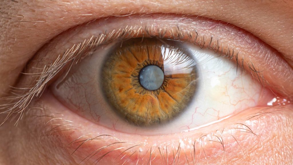 Katarakt Nedir? Belirtileri, Nedenleri ve Etkili Tedavi Yöntemleri