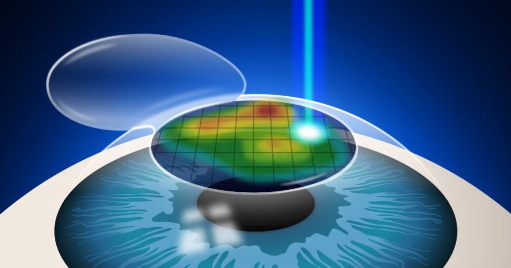 Lasik Göz Ameliyatı Nedir?