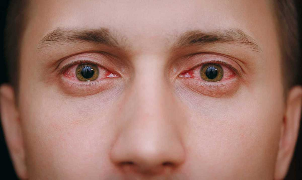 Fotokeratit Nedir?