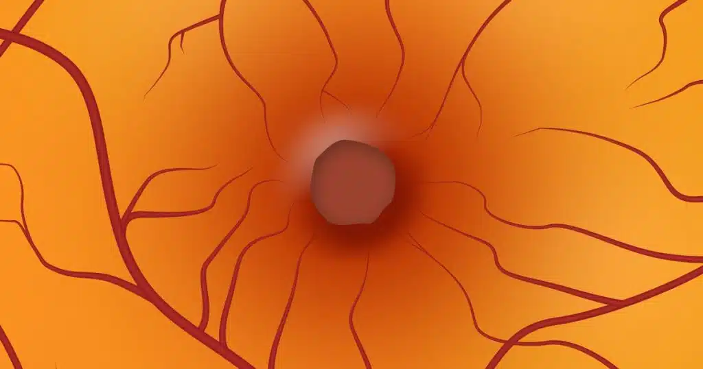 Makula Deliği Nedir?