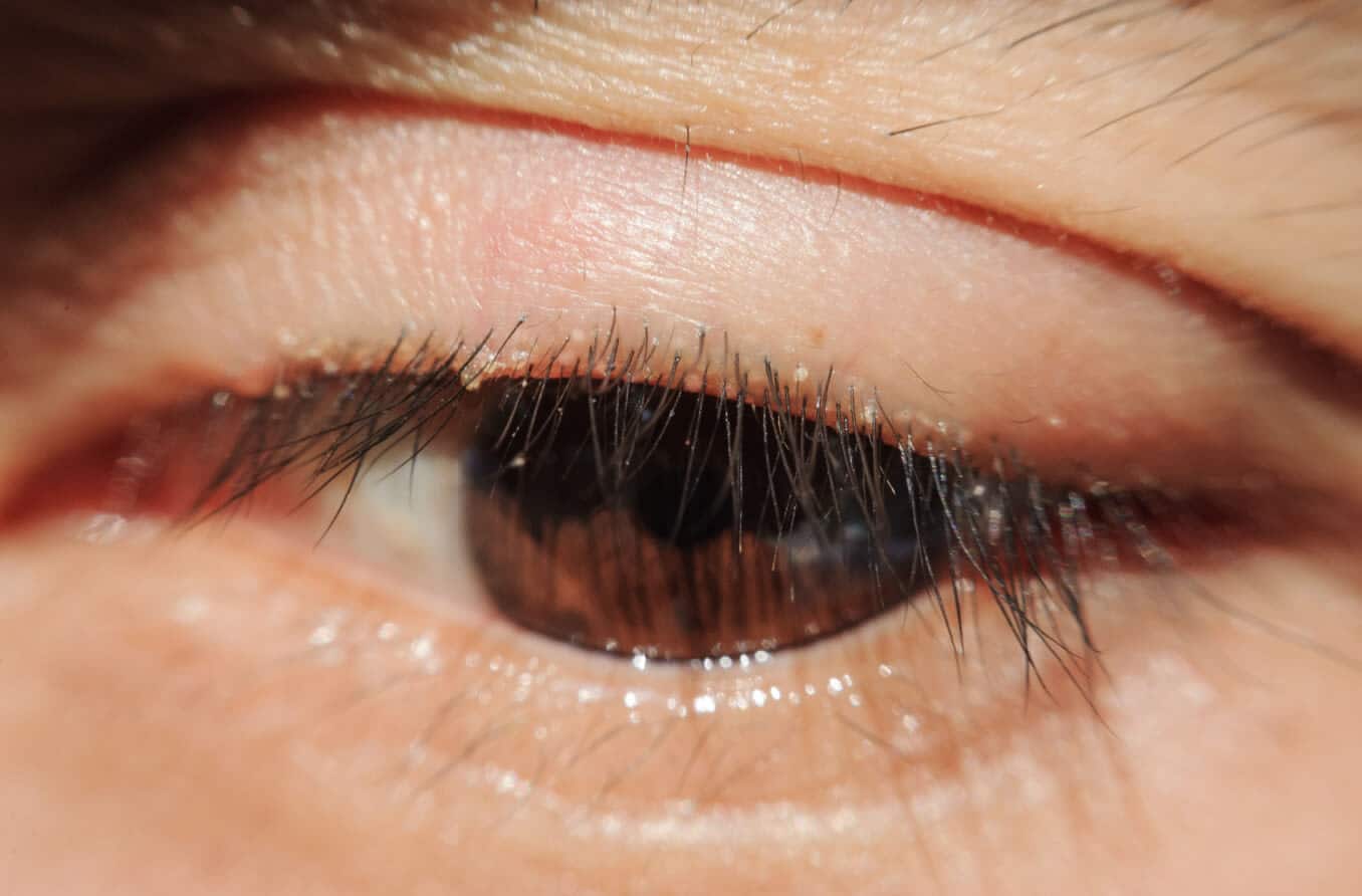 Blefarit Nedir?