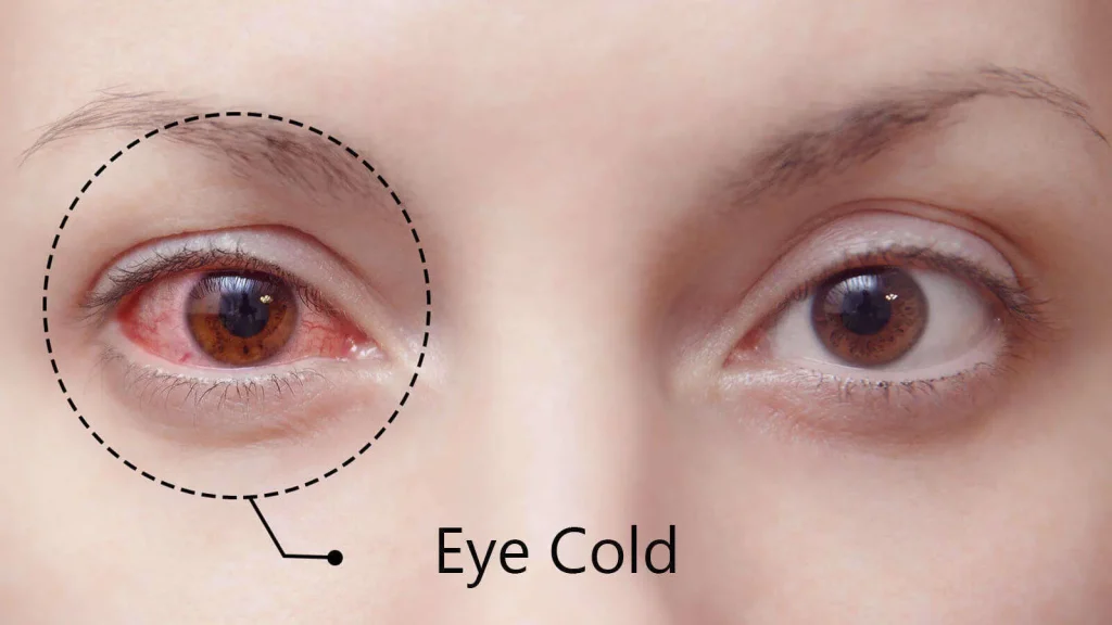 Göz Soğuk Algınlığı (Eye Cold) Nedir?