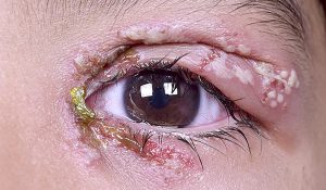 Göz Uçuğu (Ocular Herpes) Nedir?
